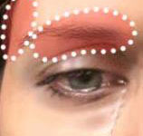 Vascular or cluster headache
